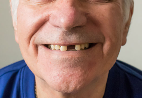 close up of man with missing front tooth