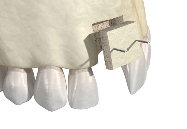 bone graft illustration