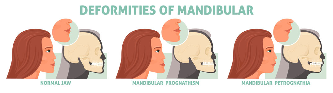 illustration of mandibular deformities